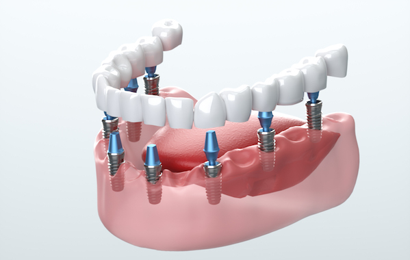 Affordable Dental Implants